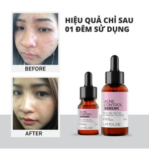 Tinh Chất Lá House Acne Control Serum Ngăn Ngừa Mụn